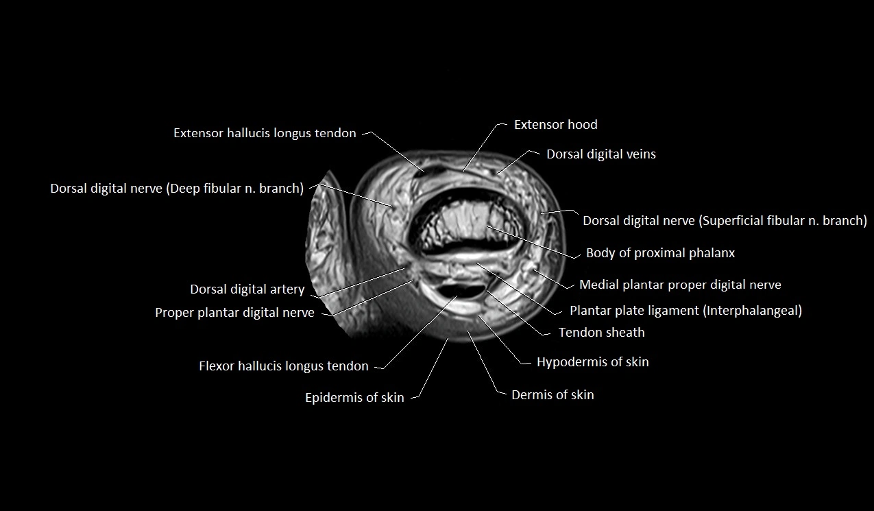 Great toe (hallux) axial microanatomy 3T MRI image 16.webp